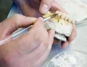 Zahnersatzt, festsitzender Zahnersatz, herausnehmbarer Zahnersatz
